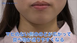 片マヒの人にお勧めの横向き嚥下