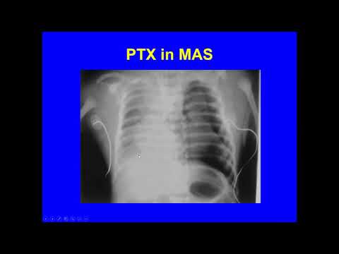 David_Meconium Aspiration Syndrome