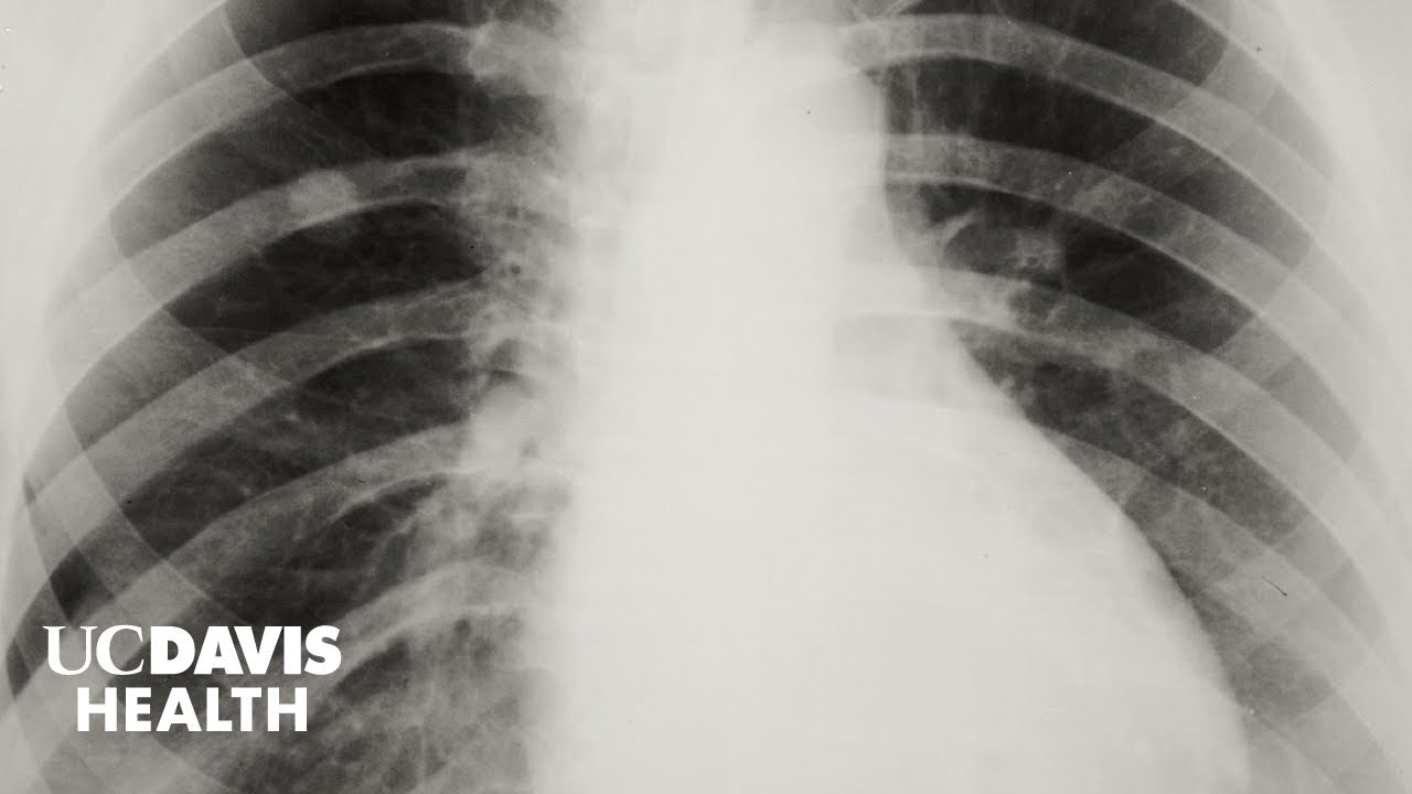 Thumbnail preview of FANS Study Examines Lung Cancer in Non-Smoking Asian American Women - Driving Discovery
