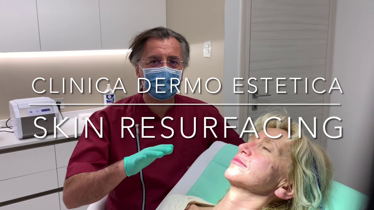 Watch Now Skin Resurfacing con laser pixel CO2 conclusione protocollo e foto prima & dopo Skin Resurfacing con laser pixel CO2 conclusione protocollo e foto prima & dopo