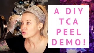 Do it Yourself Chemical Peel: Repair Winter Ravaged Skin ASAP with TCA!