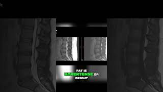 Lumbar MRI: Quick Guide to Reading Scans for Beginners