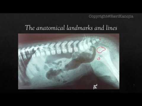 Image radiographique des malformations anorectales chez l'homme