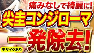 【治療動画】厄介な性病、コンジローマを一度の治療で綺麗さっぱり治しました。【抜糸】