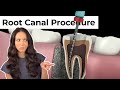 Root Canal Procedure Step by Step