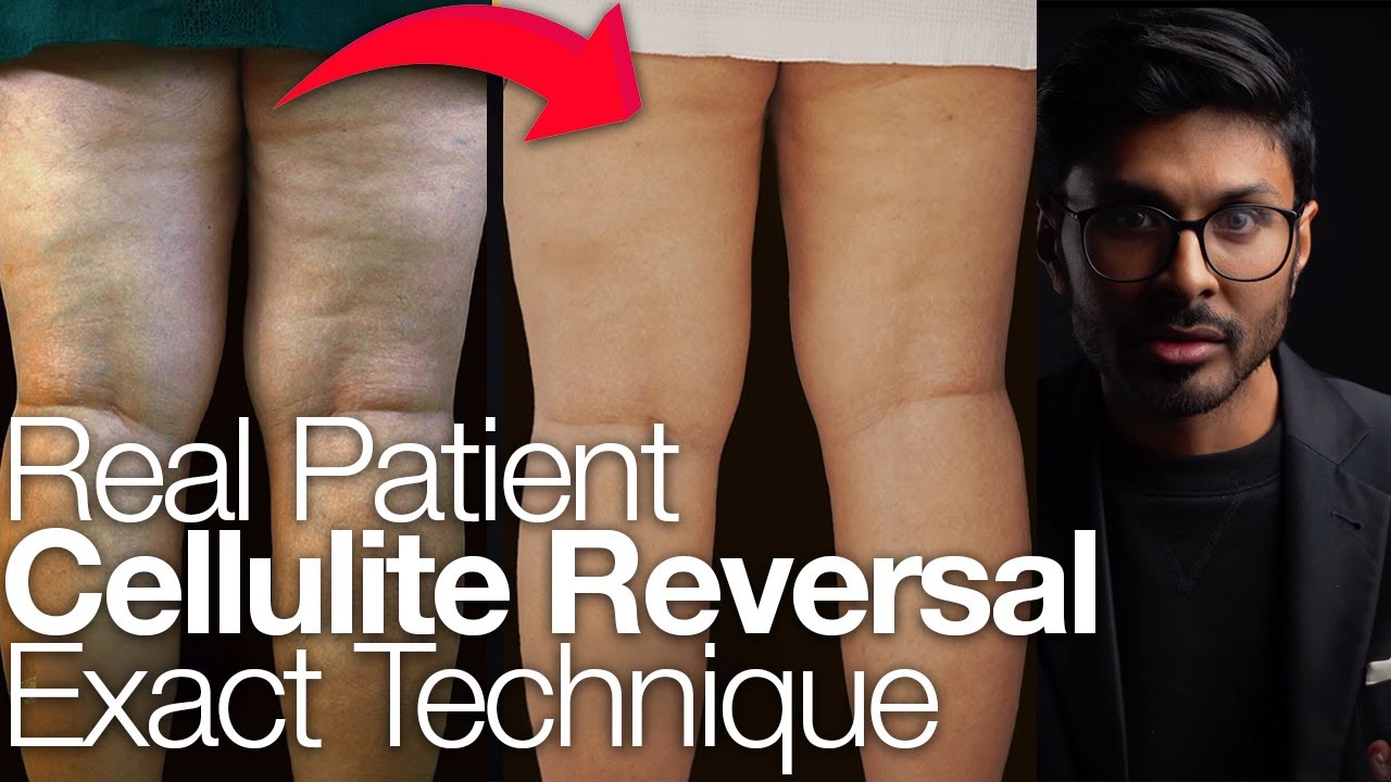 Cellulite: The ONLY Medically Licensed Reversal In The World