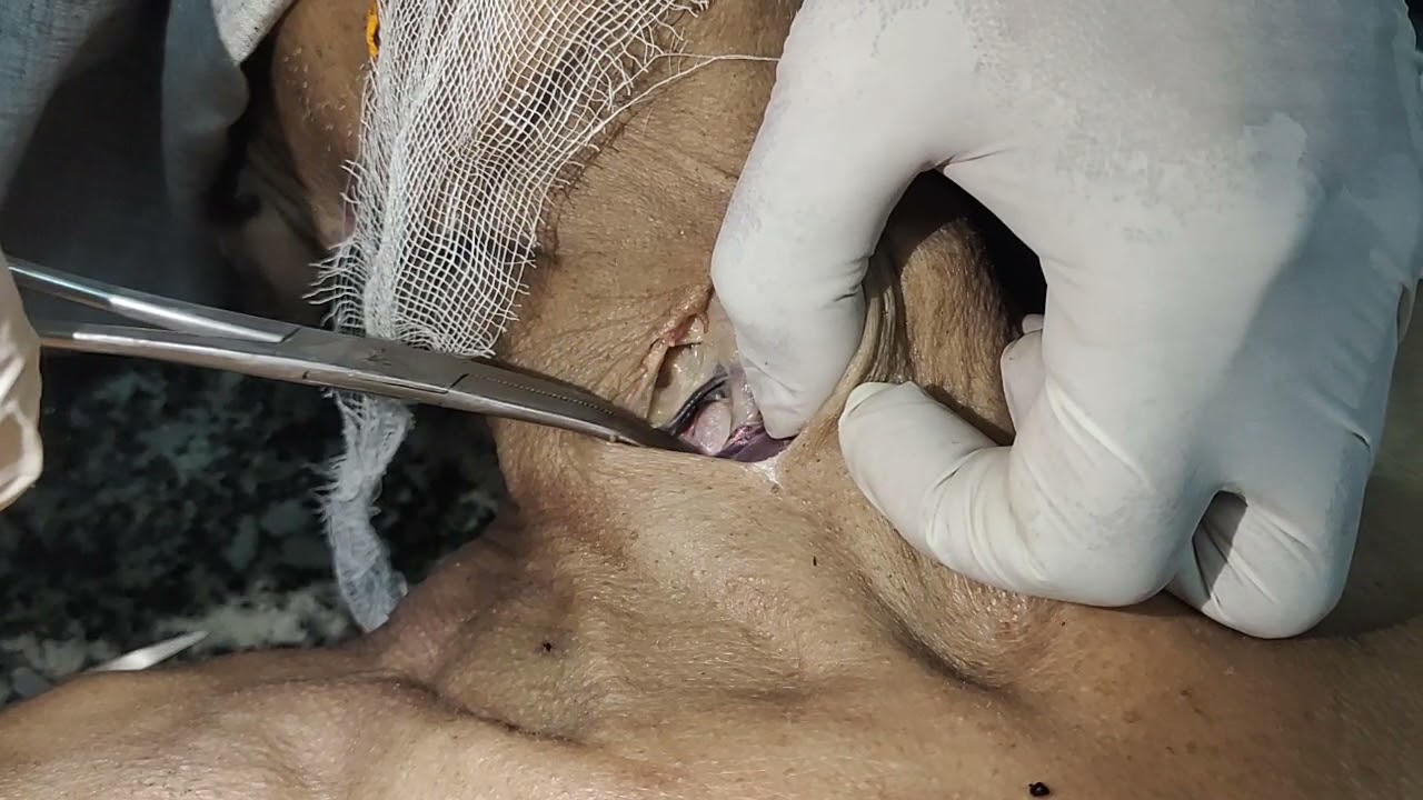 Embalming of Human Cadaver