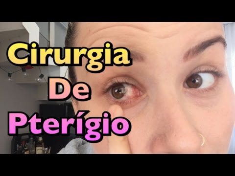 , title : 'Pré e Pós cirurgia do Pterígio'