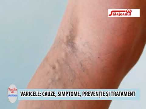 Varicoză de moarte. Cum să scapi definitiv de varice?