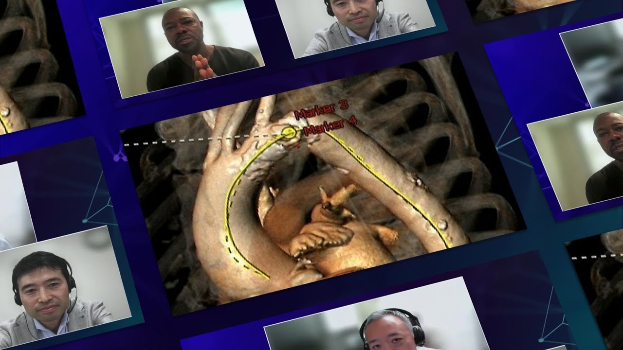 Contemporary challenges of TAVI: tailored device selection to the anatomy - Webinar