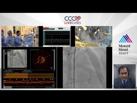 FFR & OCT Guided Staged PCI of LAD Diagonal Bifurcation - Aug 2019
