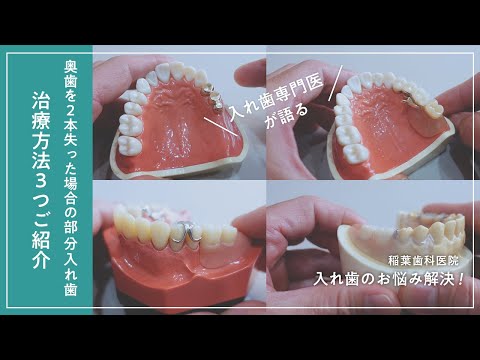 「奥歯を失った場合の部分入れ歯」治療法3つをご紹介