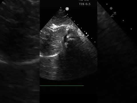 Set yourself a timer! #pocus #ultrasound  #emergencymedicine