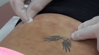 Trigger Point Injections for Shortstop, Toasted Skin Syndrome