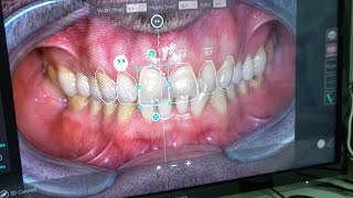 GETTING ALL NEW TEETH!