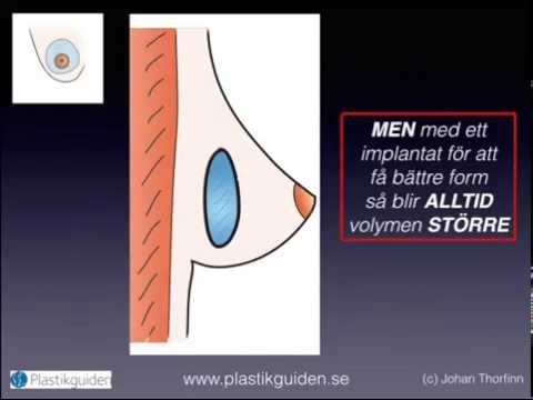 Bröstlyft med eller utan implantat