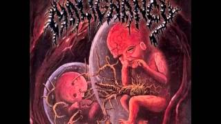 Malignancy - Intrauterine Cannibalism (1999) [Full Album] United Guttural Records