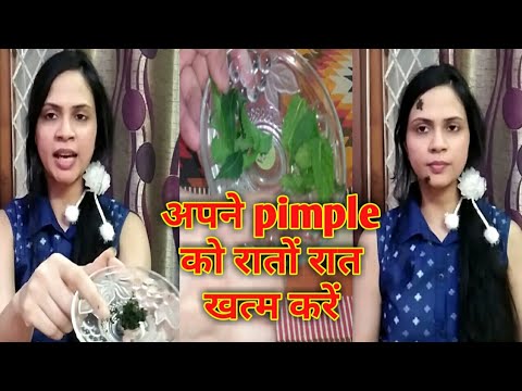 How to remove pimples/acne overnight | पिम्पल को दूर करने का घरेलू उपाय |