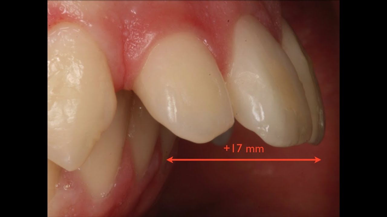 Tratamiento Ortodóncico de dientes adelantados sin extracciones (Clase II esquelética)