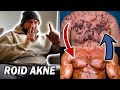 Nie wieder ROID AKNE!