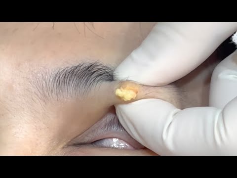 Epidermal Cyst Excision on the Eye