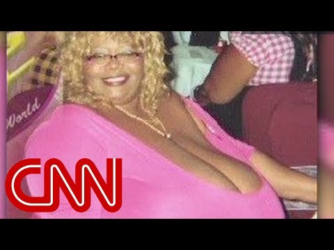 Woman's breasts weigh 89 pounds