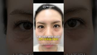 자글자글 칙칙한 눈밑, 리쥬란아이로 해결 💗