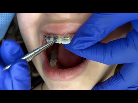 Braces check ups / Kobayashi wire hooks / Orthodontic Rubber Bands - Tooth Time New Braunfels.