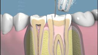 endodoncia de tres conductos