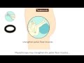 Prolapse Causes Prevention And Treatment