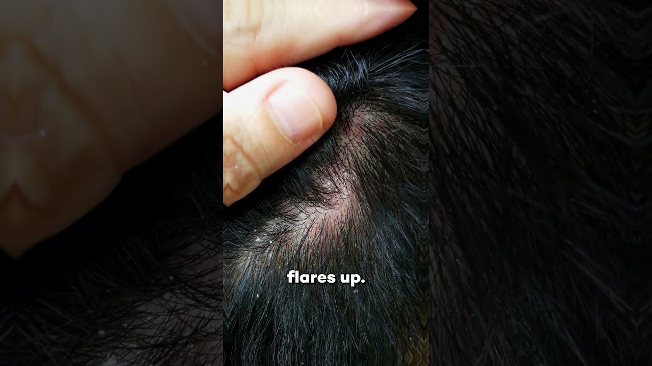 NATURALLY ELIMINATING DANDRUFF: BALANCING YOUR SCALP MICROBIOME AND STRENGTHENING THE IMMUNE SYSTEM