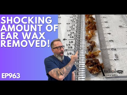 The Most Shocking Ear Wax Removal Ever - EP963