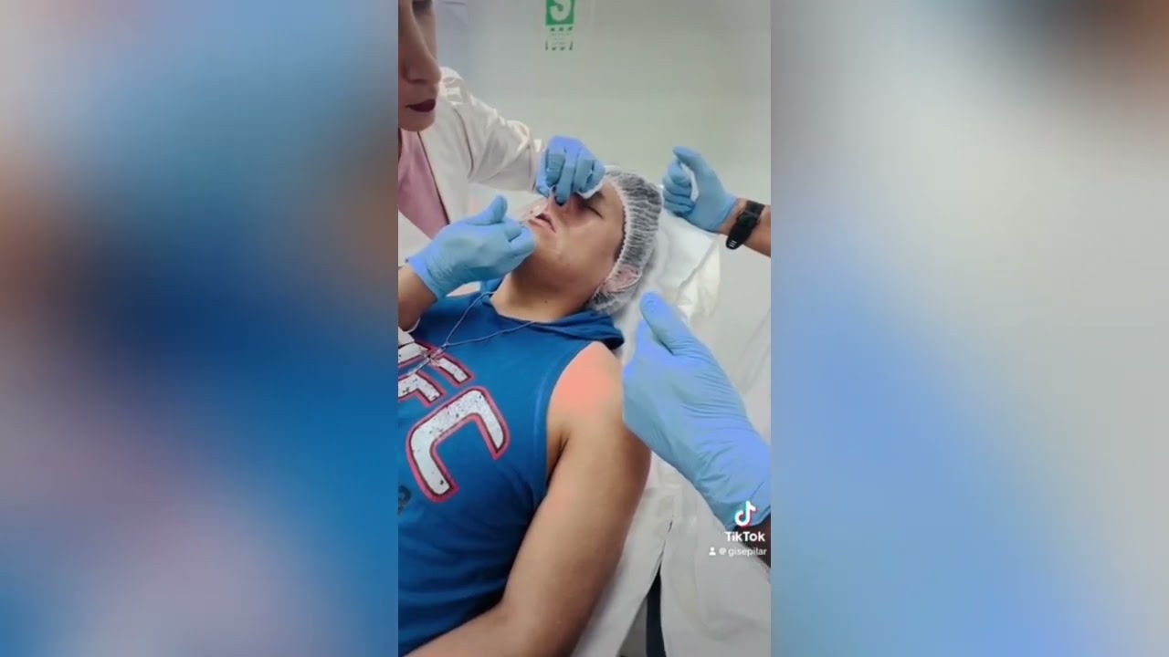Ácido Hialurónico para Rinomodelación
