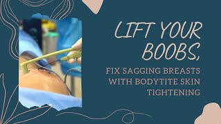 LIFT YOUR BOOBS,  FIX SAGGING BREASTS WITH BODYTITE SKIN TIGHTENING | West Hollywood |Dr. Jason Emer
