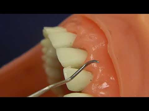 How to Use Universal Curettes