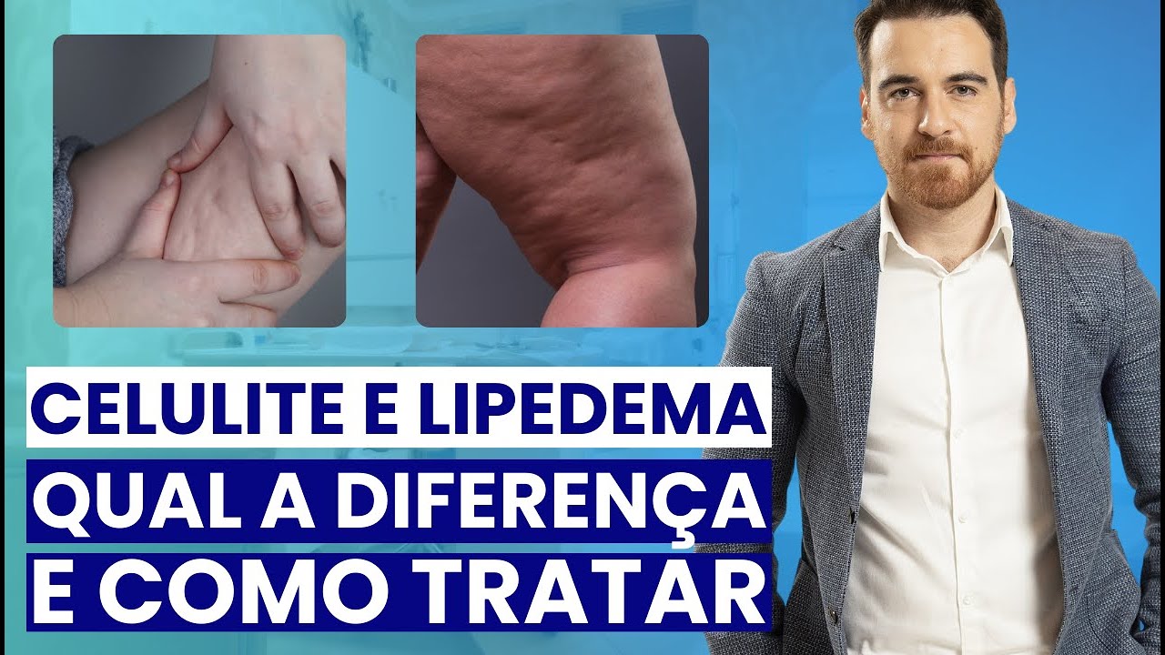 Celulite e Lipedema: Qual a diferença e como tratar para emagrecer