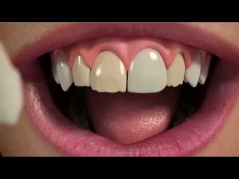 تجميل الاسنان - شرح حالة الفينير