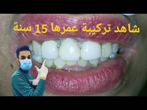 , title : 'ازالة تركيبة اسنان ثابته عمرها 15سنه انظر ماذا رأينا تحتها Removing a 15-year-old fixed dental'