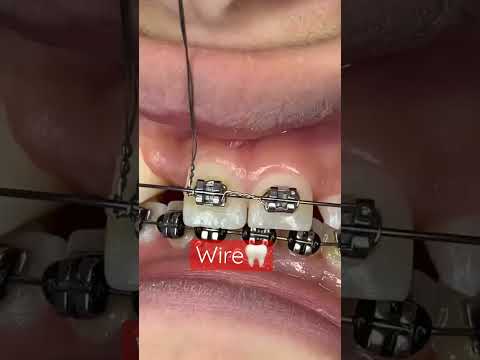 Orthodontic Treatment |Fixed Braces |Ligature,Power Chain |OrthoDentistry🦷
