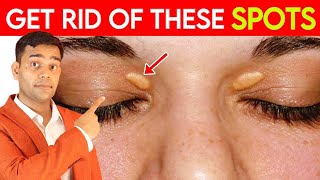 Get Rid Of These Spots | Fat Under Eyes |  Xanthelasma |  Natural Remedies - Dr. Vivek Joshi