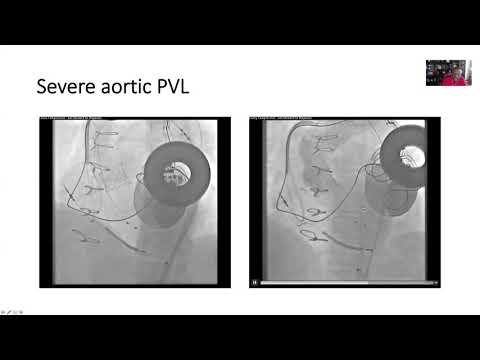 Aortic Malposition - Oluseun Alli, MD