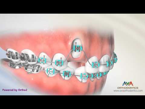 Orthodontic Treatment for Impacted Canine - Laser Exposure