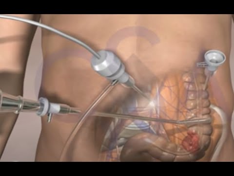Colorectal Cancer Surgery 3D Medical Animation - Laparoscopic Procedure