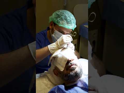 The hair transplant journey of our beloved patient #hairtransplant