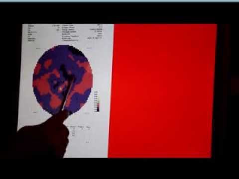 FIRATLI CLINIC ISTANBUL- Stargardt Disease Treatment(Proof)-Wasim after 20 Sessions