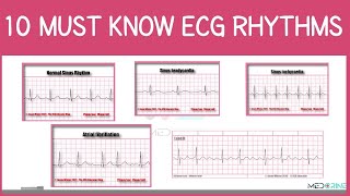 Top 10 MUST-KNOW Electrocardiogram (ECG) Rhythms Simplified! | ECG Interpretation Made Easy