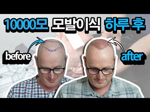 10,000모 모발이식 before & after ???? | 이식수술 다음 날엔 어떤 일이…? 모발이식 비포앤애프터 [비절개모발이식]