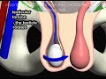 Testicular Torsion Animation By Cal Shipley M D