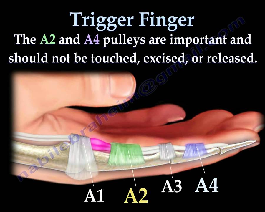 Trigger Finger and trigger thumb - Everything You Need To Know - Dr. Nabil Ebraheim - YouTube