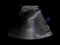 POCUS Lung Ultrasound Understanding B Lines And Hepatization